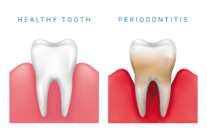 Healthy tooth and Periodontics