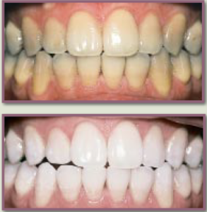 difference between - before and after teeth whitening